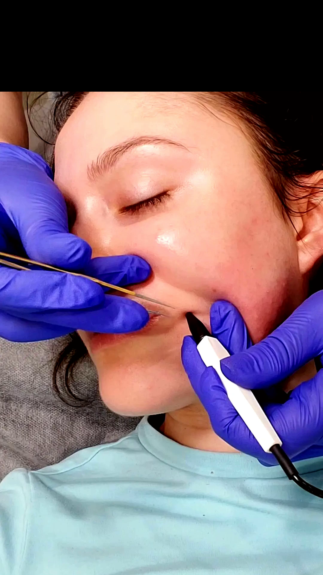 Precise facial electrolysis treatment in the Beautique Artistry treatment room