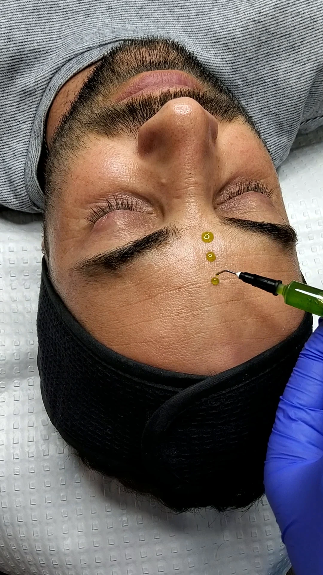 Three BioRePeel drops applied during a chemical peel treatment at Beautique Artistry