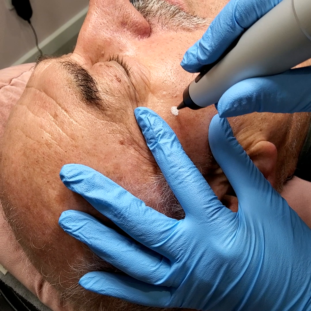 CryoPen treatment being performed on a client's face