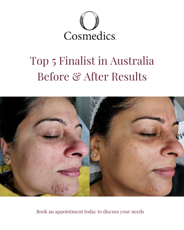 Before and after skin treatment result 1
